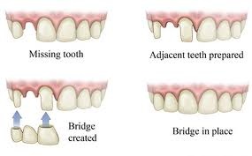 Dental-Bridge-steps