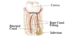 Root Canal Treatments at Ardent Dental NorthVancouver